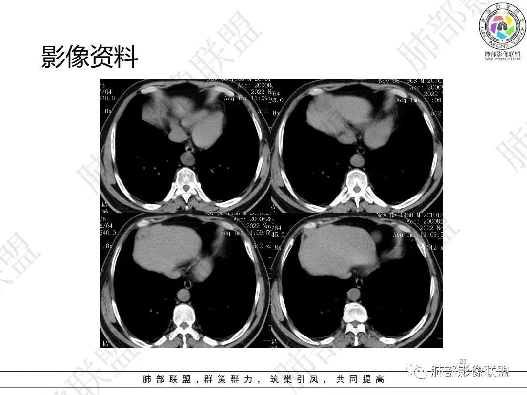 影像PPT - 【病例】大支气管内肿瘤的异类-23 影像PPT - 【病例】大支气管内肿瘤的异类-23
