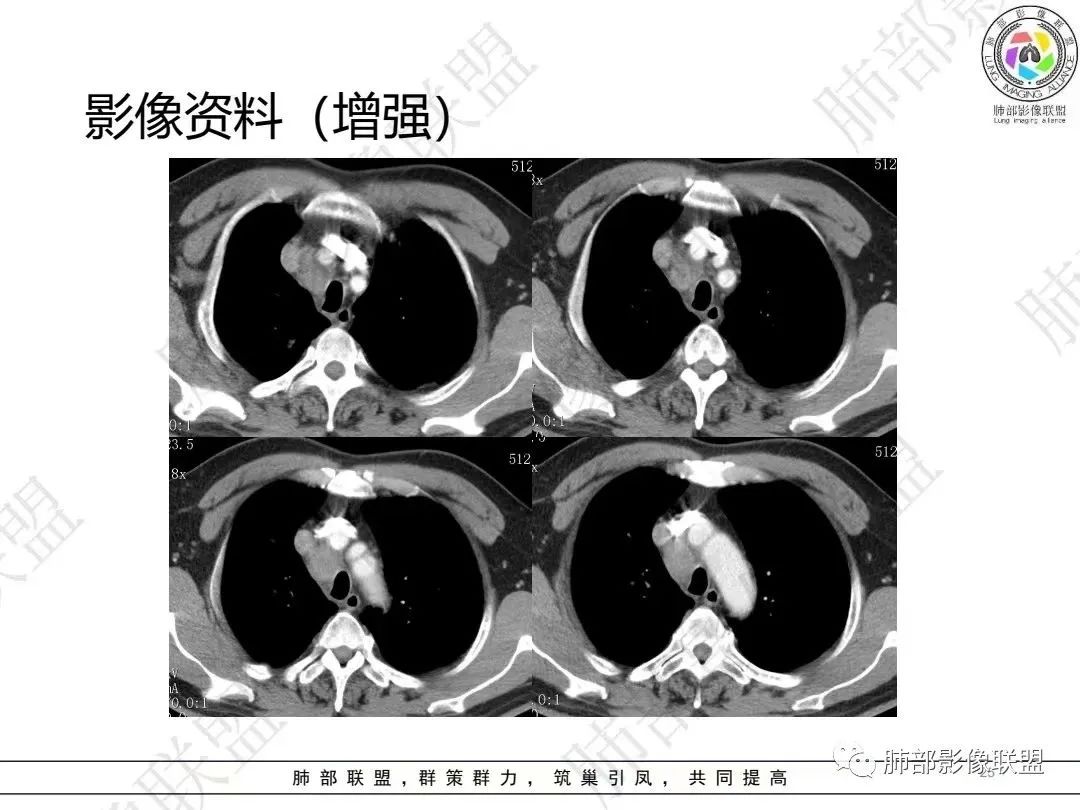 影像PPT - 【病例】大支气管内肿瘤的异类-25 影像PPT - 【病例】大支气管内肿瘤的异类-25