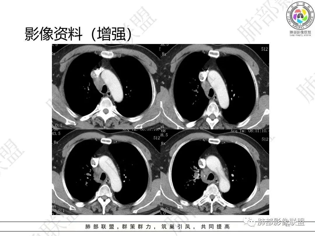 影像PPT - 【病例】大支气管内肿瘤的异类-26 影像PPT - 【病例】大支气管内肿瘤的异类-26