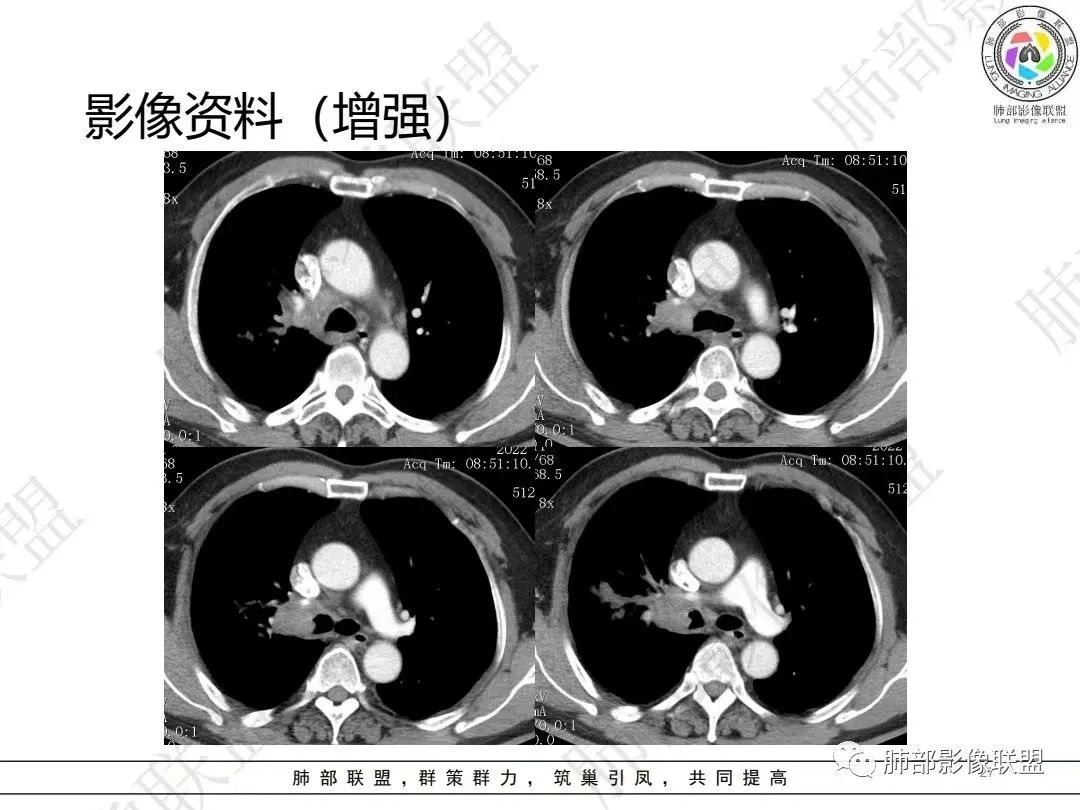 影像PPT - 【病例】大支气管内肿瘤的异类-27 影像PPT - 【病例】大支气管内肿瘤的异类-27