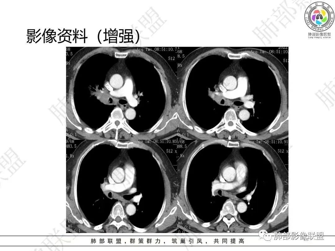影像PPT - 【病例】大支气管内肿瘤的异类-28 影像PPT - 【病例】大支气管内肿瘤的异类-28