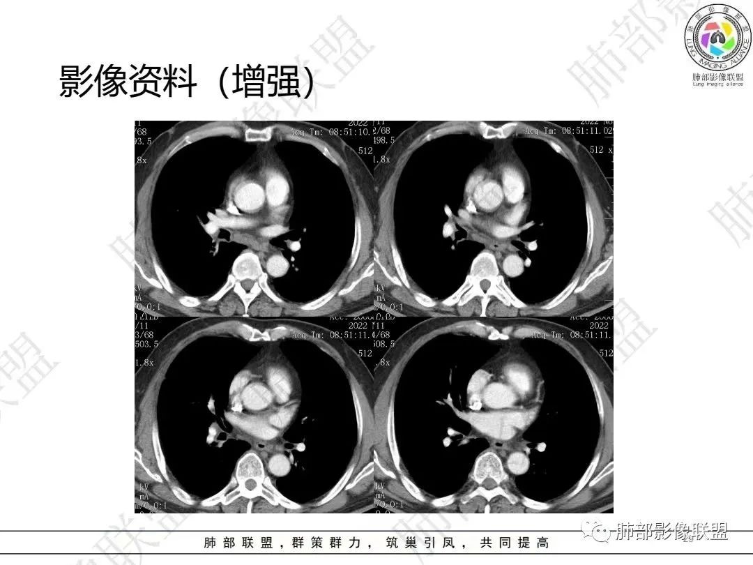 影像PPT - 【病例】大支气管内肿瘤的异类-29 影像PPT - 【病例】大支气管内肿瘤的异类-29