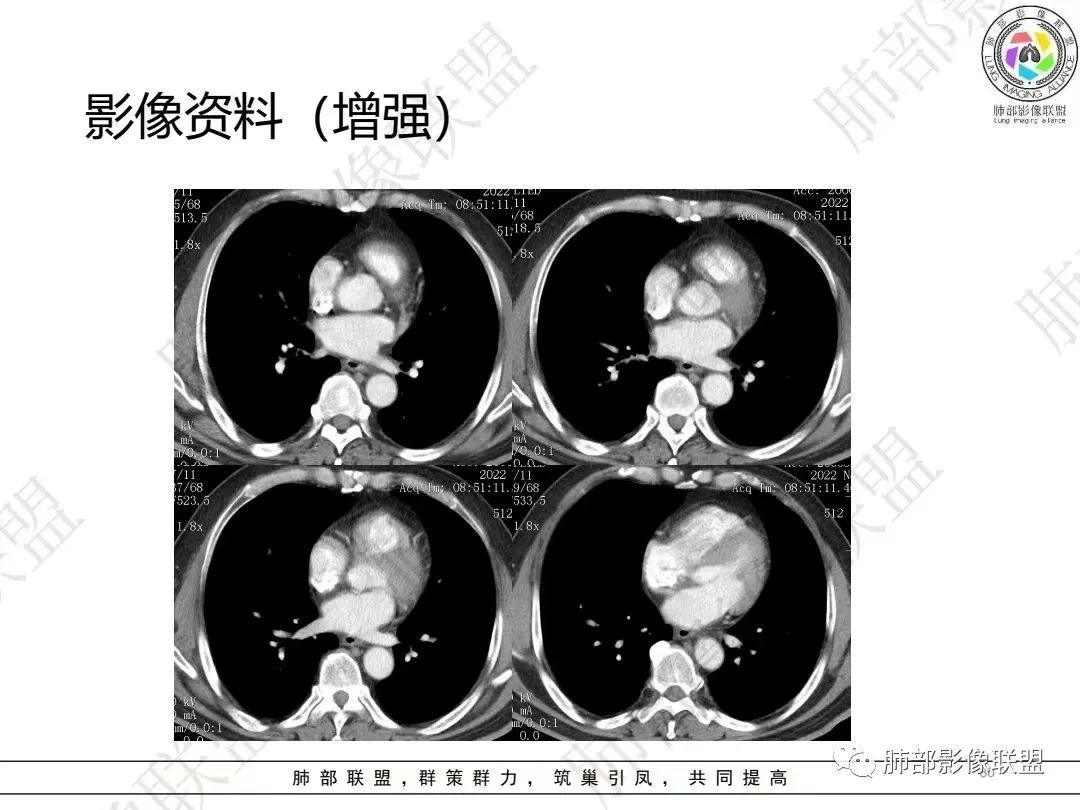 影像PPT - 【病例】大支气管内肿瘤的异类-30 影像PPT - 【病例】大支气管内肿瘤的异类-30