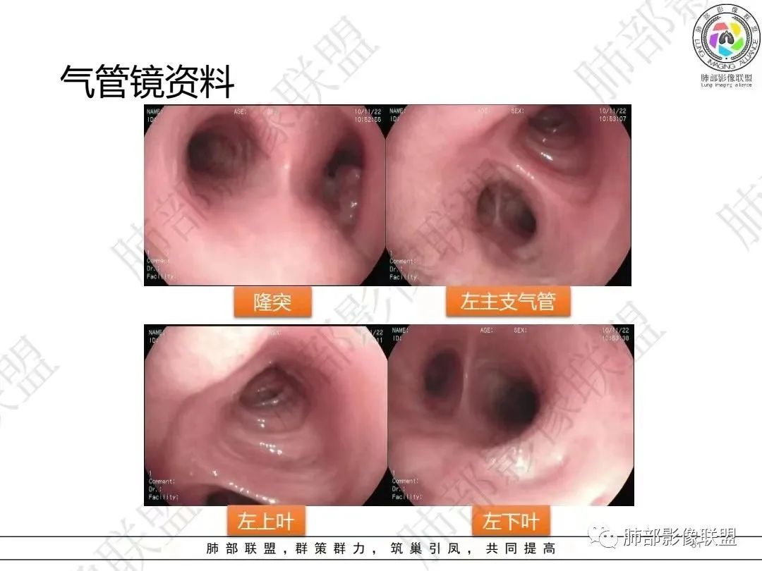 影像PPT - 【病例】大支气管内肿瘤的异类-31 影像PPT - 【病例】大支气管内肿瘤的异类-31