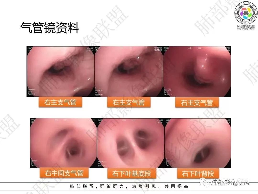 影像PPT - 【病例】大支气管内肿瘤的异类-32 影像PPT - 【病例】大支气管内肿瘤的异类-32
