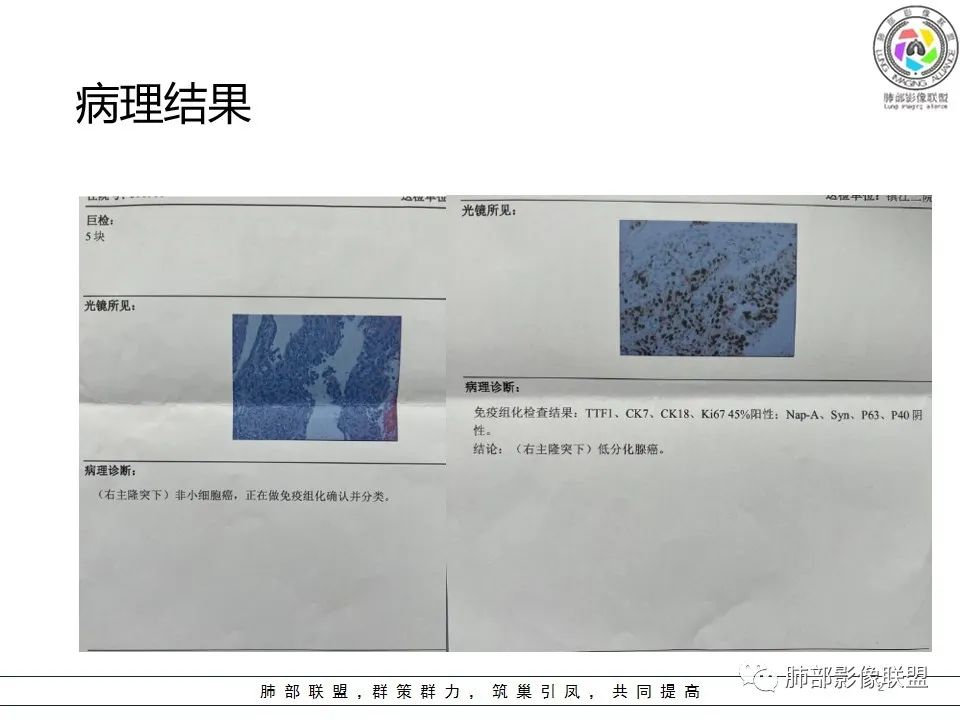 影像PPT - 【病例】大支气管内肿瘤的异类-35 影像PPT - 【病例】大支气管内肿瘤的异类-35