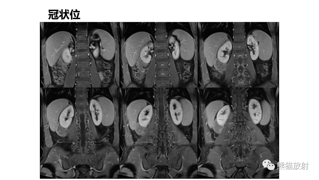 影像PPT - 【病例】肾血管平滑肌脂肪瘤AML二例影像-7