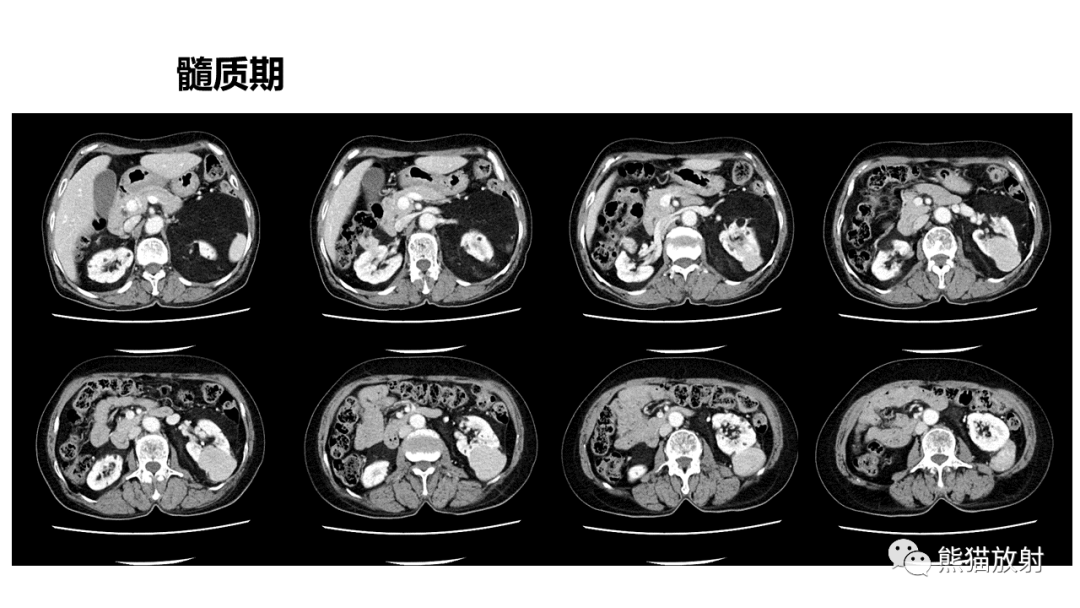 影像PPT - 【病例】肾血管平滑肌脂肪瘤AML二例影像-12