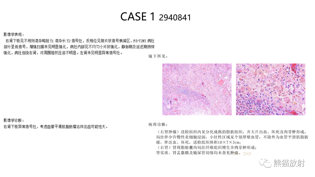 影像PPT - 【病例】肾血管平滑肌脂肪瘤AML二例影像-14