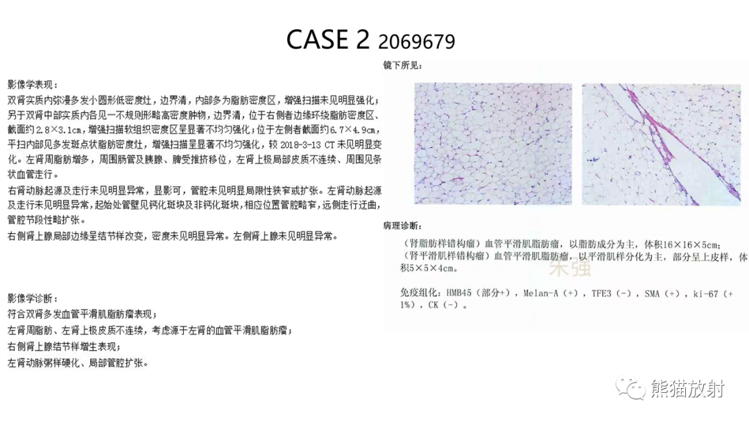 影像PPT - 【病例】肾血管平滑肌脂肪瘤AML二例影像-15