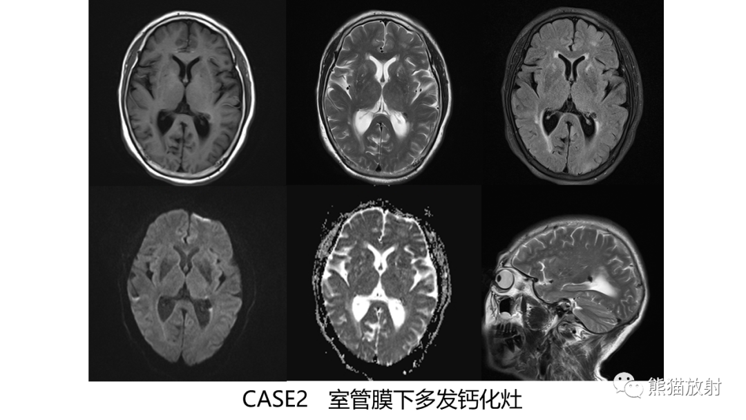 影像PPT - 【病例】肾血管平滑肌脂肪瘤AML二例影像-20