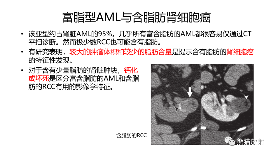 影像PPT - 【病例】肾血管平滑肌脂肪瘤AML二例影像-22