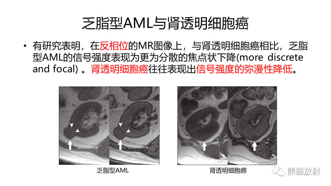 影像PPT - 【病例】肾血管平滑肌脂肪瘤AML二例影像-25