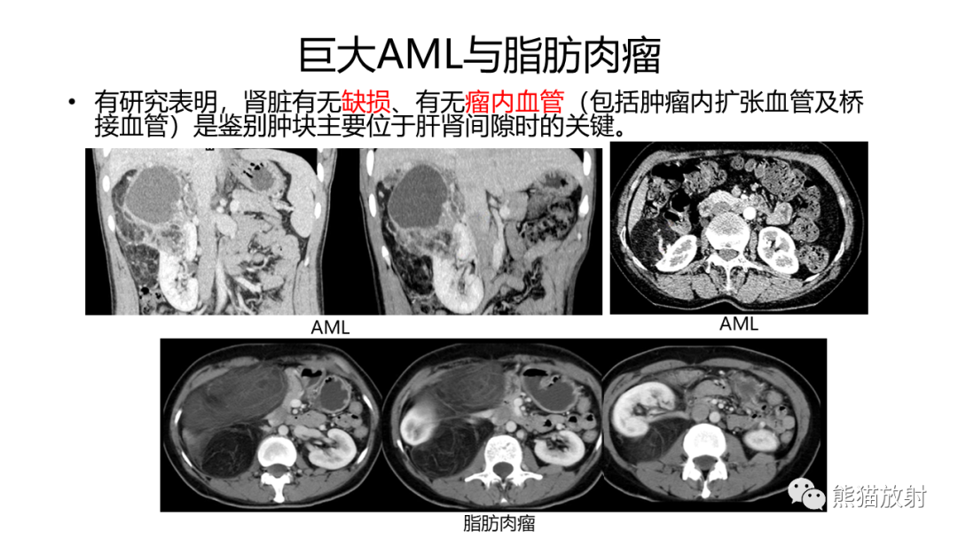 影像PPT - 【病例】肾血管平滑肌脂肪瘤AML二例影像-28