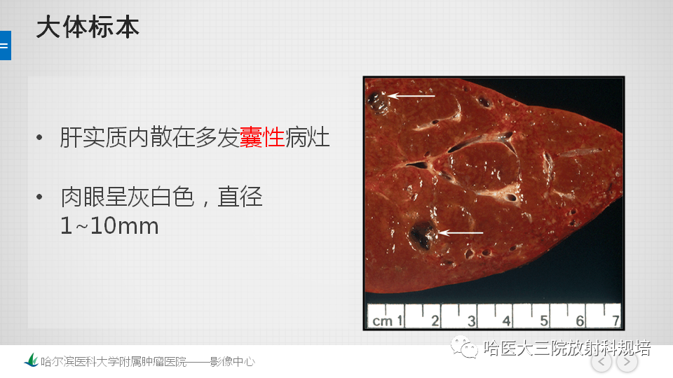 影像PPT - 【PPT】肝内胆管错构瘤的影像诊断-8