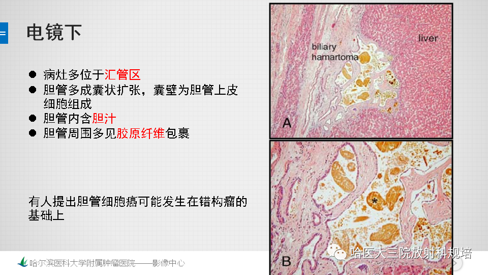 影像PPT - 【PPT】肝内胆管错构瘤的影像诊断-9