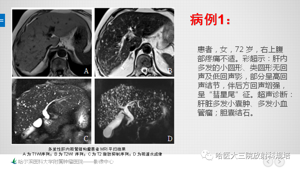 影像PPT - 【PPT】肝内胆管错构瘤的影像诊断-16