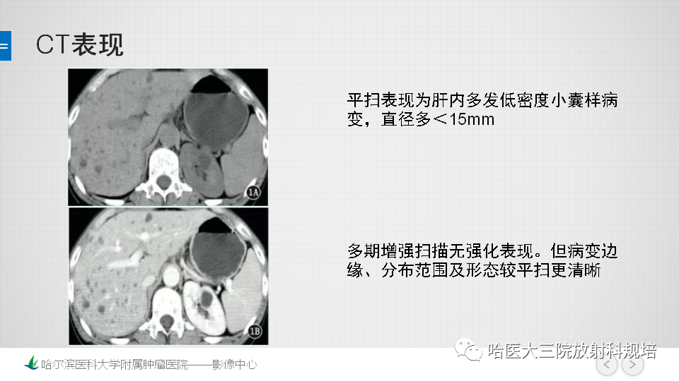 影像PPT - 【PPT】肝内胆管错构瘤的影像诊断-14