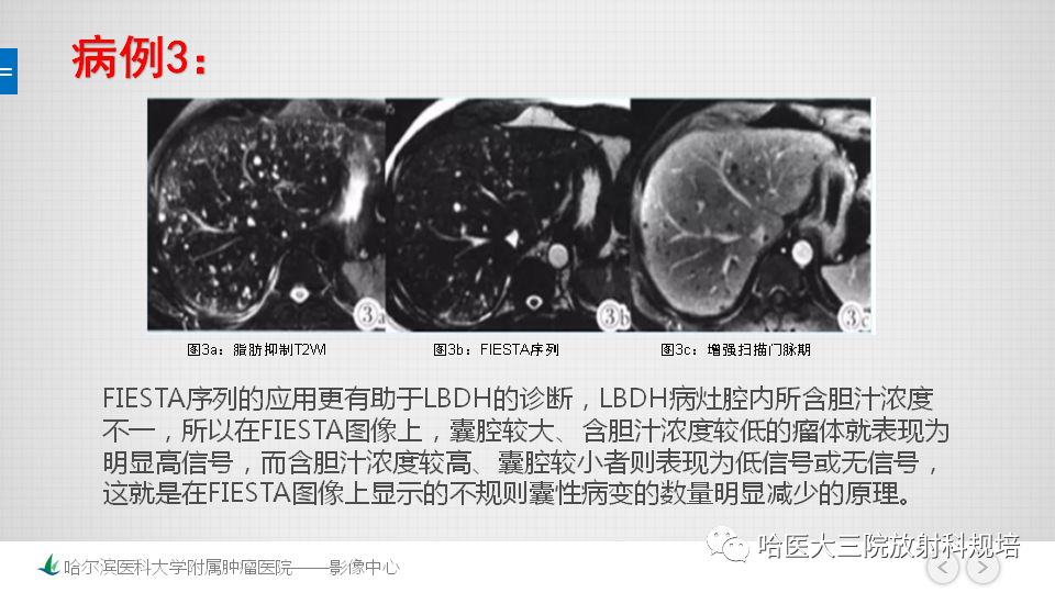 影像PPT - 【PPT】肝内胆管错构瘤的影像诊断-18