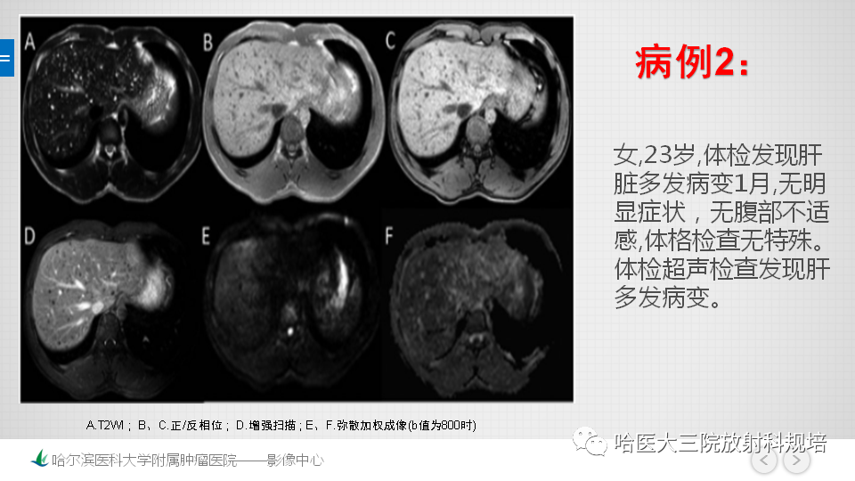 影像PPT - 【PPT】肝内胆管错构瘤的影像诊断-17