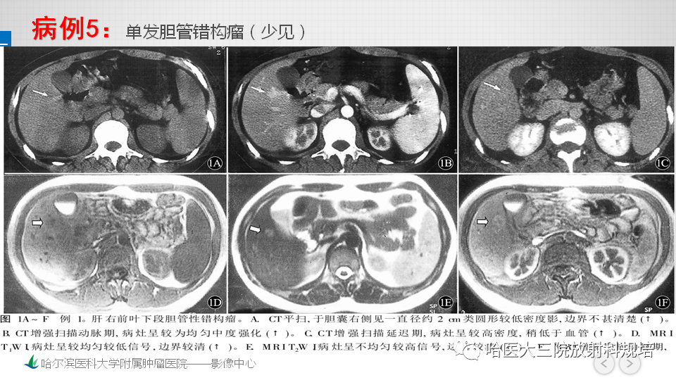 影像PPT - 【PPT】肝内胆管错构瘤的影像诊断-20