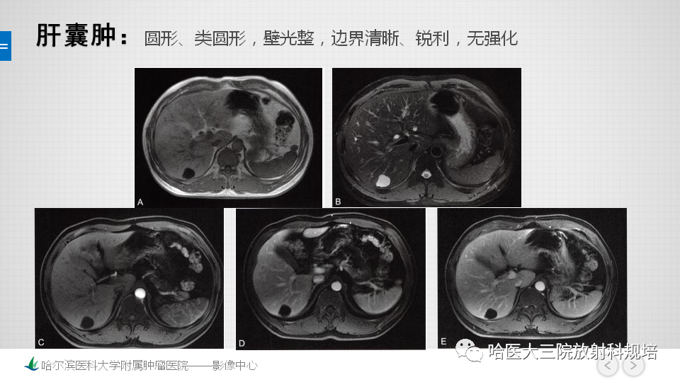 影像PPT - 【PPT】肝内胆管错构瘤的影像诊断-23