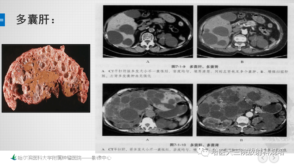 影像PPT - 【PPT】肝内胆管错构瘤的影像诊断-24