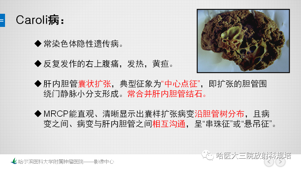 影像PPT - 【PPT】肝内胆管错构瘤的影像诊断-25
