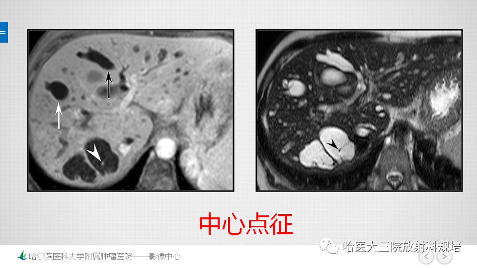 影像PPT - 【PPT】肝内胆管错构瘤的影像诊断-26