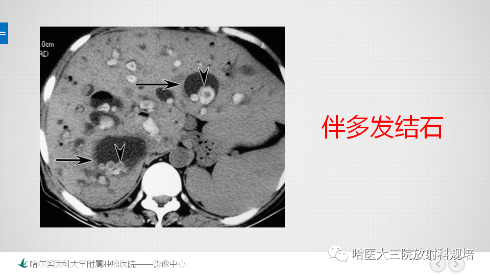 影像PPT - 【PPT】肝内胆管错构瘤的影像诊断-27