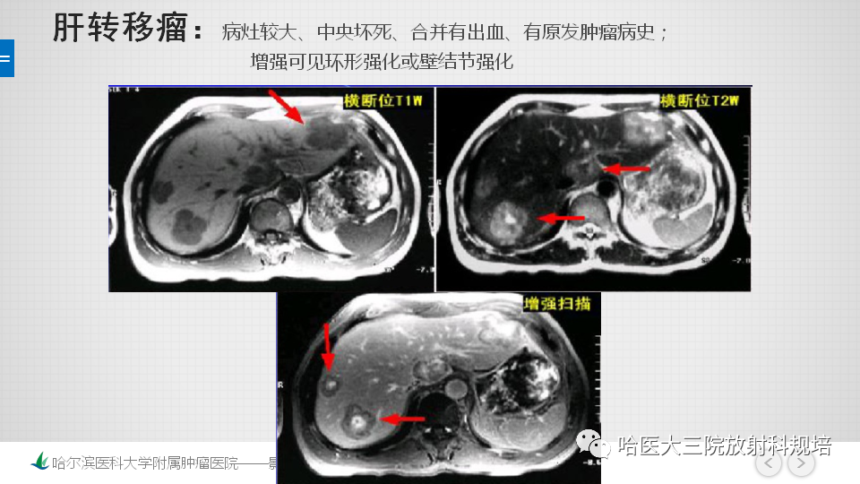 影像PPT - 【PPT】肝内胆管错构瘤的影像诊断-29