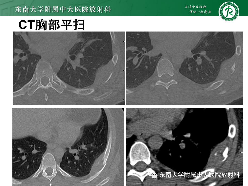 影像PPT - 【病例】肋骨孤立性溶骨性病变病例讨论-3