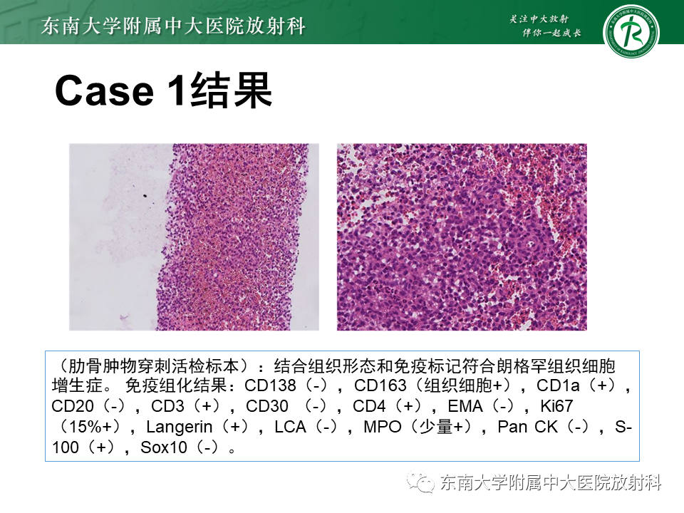 影像PPT - 【病例】肋骨孤立性溶骨性病变病例讨论-5