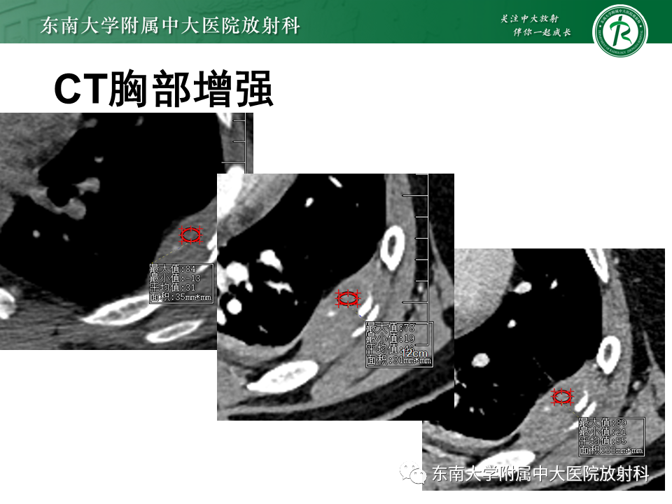 影像PPT - 【病例】肋骨孤立性溶骨性病变病例讨论-4