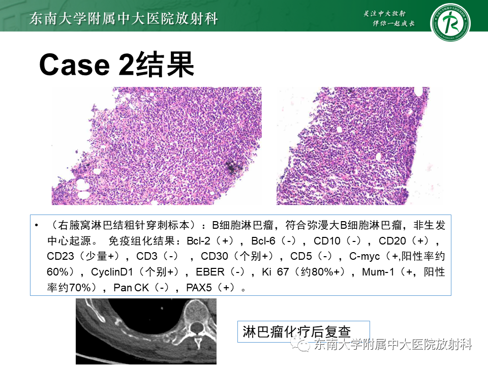 影像PPT - 【病例】肋骨孤立性溶骨性病变病例讨论-7