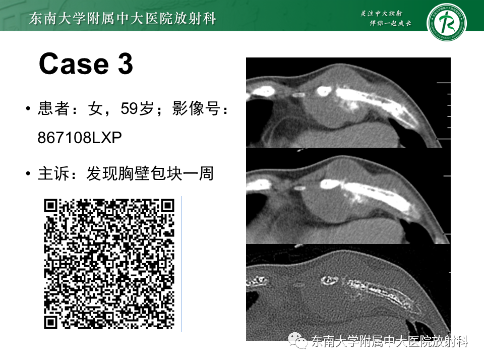 影像PPT - 【病例】肋骨孤立性溶骨性病变病例讨论-8