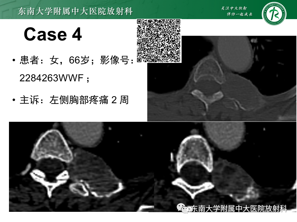 影像PPT - 【病例】肋骨孤立性溶骨性病变病例讨论-10