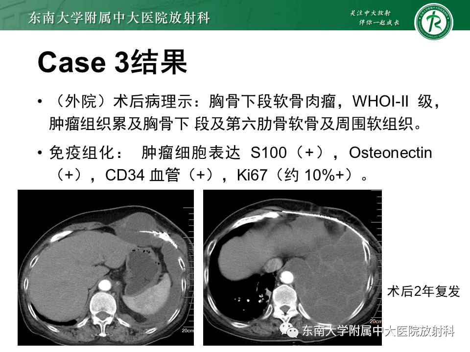 影像PPT - 【病例】肋骨孤立性溶骨性病变病例讨论-9
