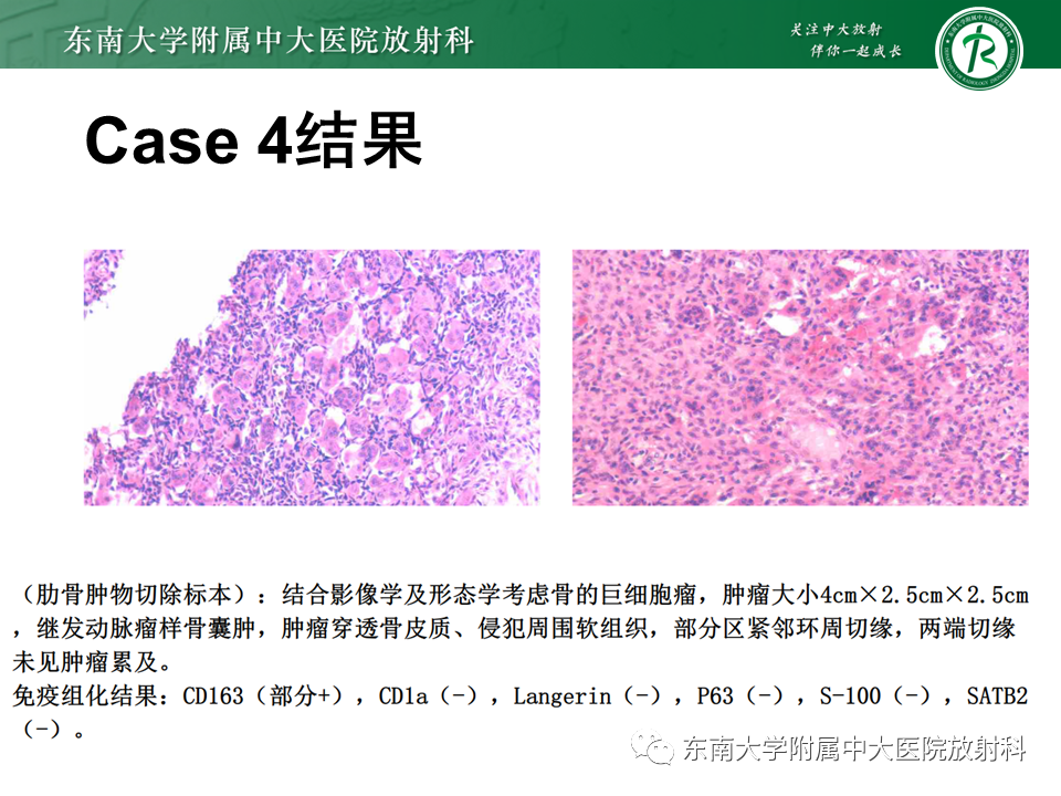 影像PPT - 【病例】肋骨孤立性溶骨性病变病例讨论-11