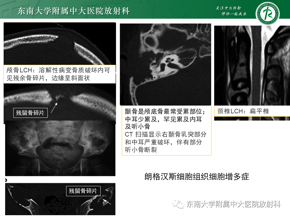 影像PPT - 【病例】肋骨孤立性溶骨性病变病例讨论-18