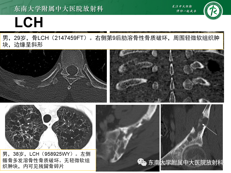 影像PPT - 【病例】肋骨孤立性溶骨性病变病例讨论-20