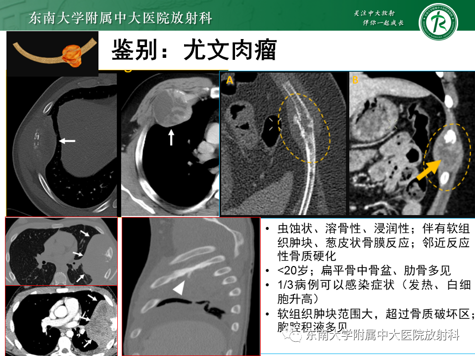 影像PPT - 【病例】肋骨孤立性溶骨性病变病例讨论-21