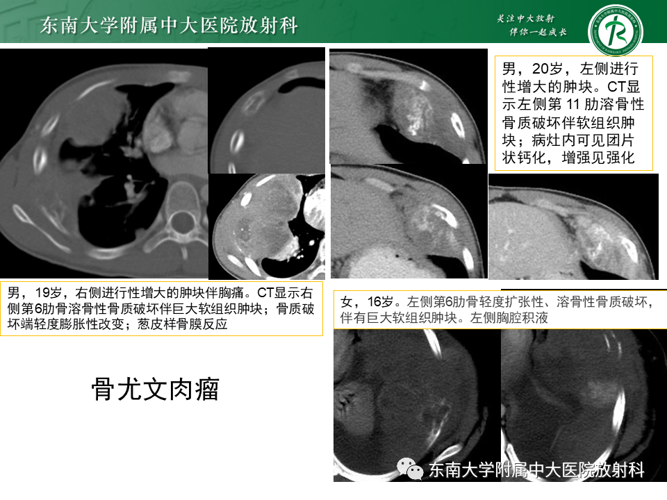 影像PPT - 【病例】肋骨孤立性溶骨性病变病例讨论-23