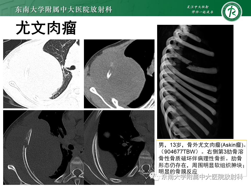 影像PPT - 【病例】肋骨孤立性溶骨性病变病例讨论-24
