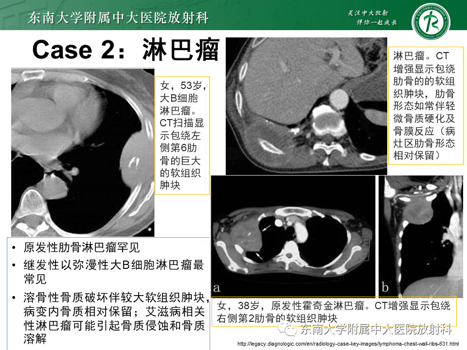 影像PPT - 【病例】肋骨孤立性溶骨性病变病例讨论-25