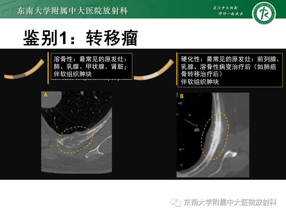 影像PPT - 【病例】肋骨孤立性溶骨性病变病例讨论-26