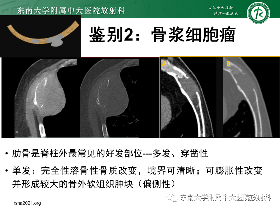 影像PPT - 【病例】肋骨孤立性溶骨性病变病例讨论-27