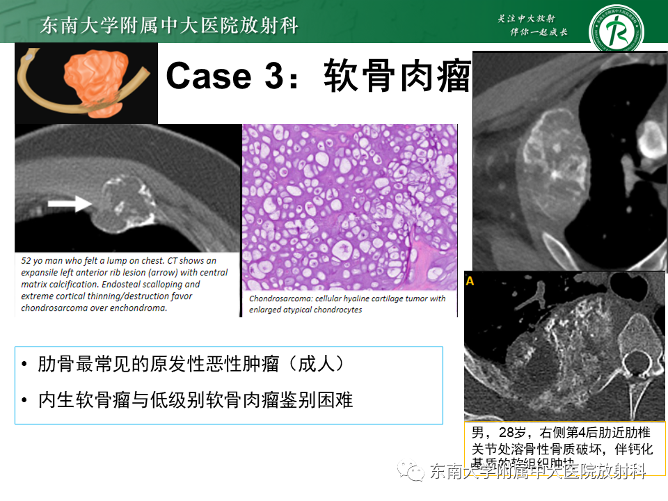 影像PPT - 【病例】肋骨孤立性溶骨性病变病例讨论-28