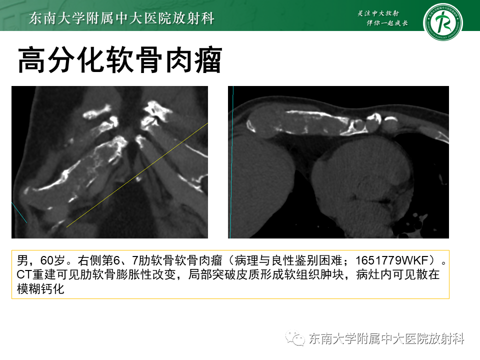 影像PPT - 【病例】肋骨孤立性溶骨性病变病例讨论-30