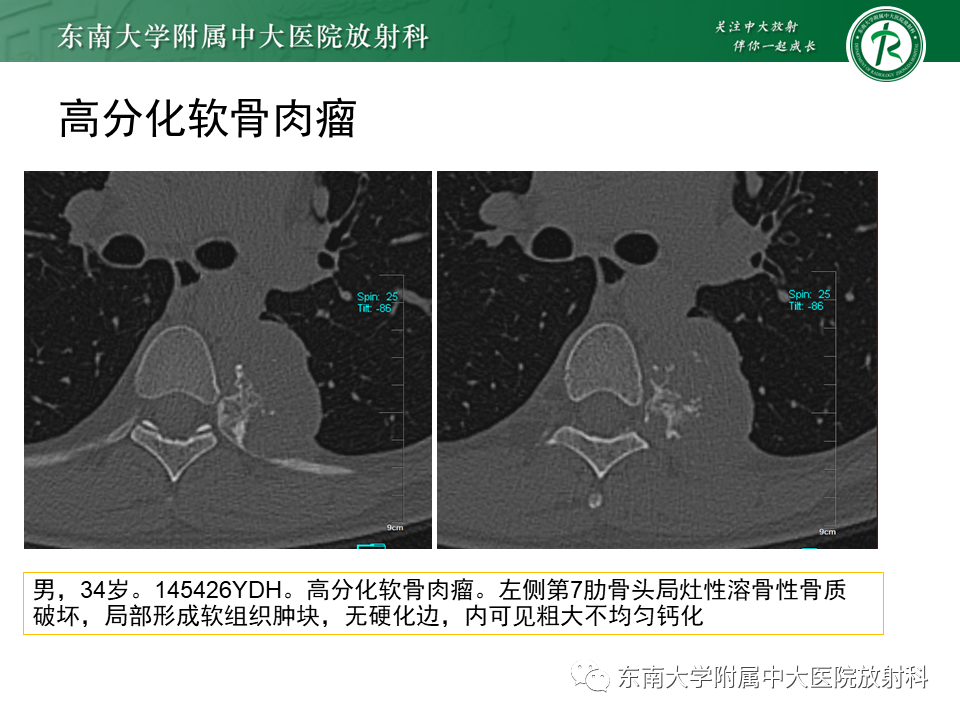 影像PPT - 【病例】肋骨孤立性溶骨性病变病例讨论-31